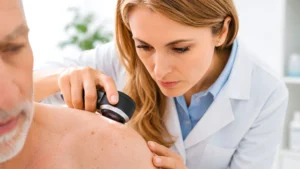 melanoma